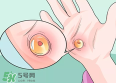水泡怎么處理？水泡要不要刺破？