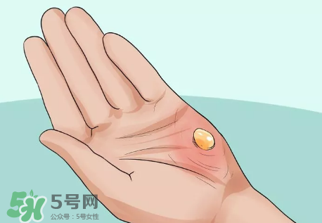 水泡怎么處理？水泡要不要刺破？
