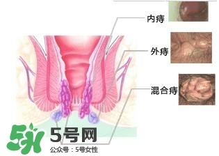 痔瘡吃什么藥效果好？痔瘡吃什么藥好得快？