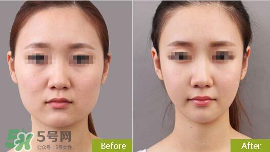 瘦臉針分為幾種類型？瘦臉針有哪幾個(gè)牌子？