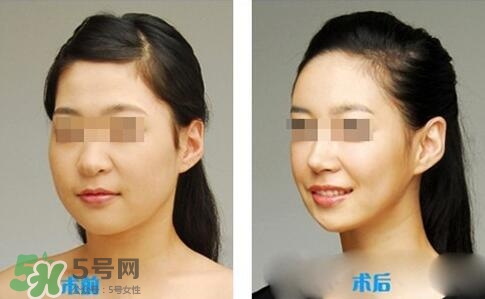 瘦臉針分為幾種類型？瘦臉針有哪幾個(gè)牌子？