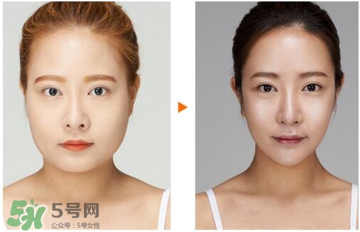 瘦臉針分為幾種類型？瘦臉針有哪幾個(gè)牌子？