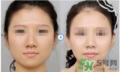 打瘦臉針疼不疼？打瘦臉針的注意事項(xiàng)