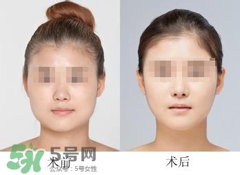 打瘦臉針能喝酒嗎？打瘦臉針能吃海鮮嗎？
