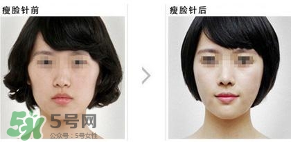 打瘦臉針能喝酒嗎？打瘦臉針能吃海鮮嗎？