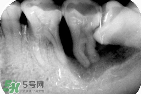 智齒會(huì)引起耳鳴嗎？耳鳴跟智齒有關(guān)系嗎？