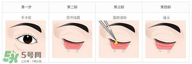 眼袋是怎么形成的？手術(shù)去眼袋安全嗎