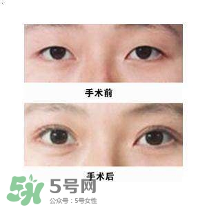 割雙眼皮疼不疼？割雙眼皮疼幾天能好？
