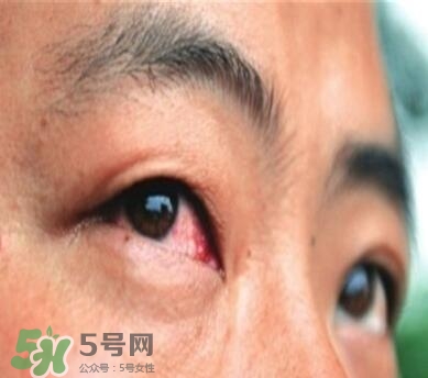 紅眼病是怎么引起的？紅眼病怎么產(chǎn)生的