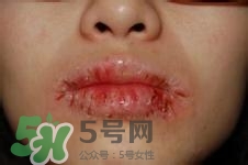 嘴唇干燥是什么原因？嘴唇干裂脫皮怎么辦？