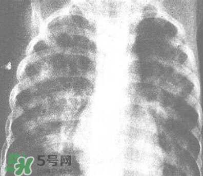 紅眼病是怎么引起的？紅眼病怎么產(chǎn)生的
