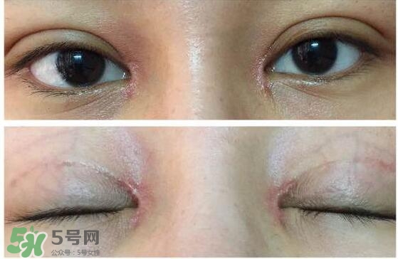 眼角增生是什么意思？眼角增生了怎么辦？