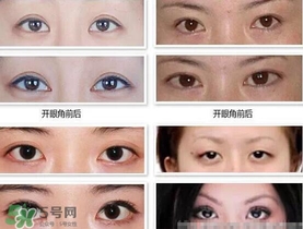 哪些人需要開眼角？需要開眼角的眼睛圖片