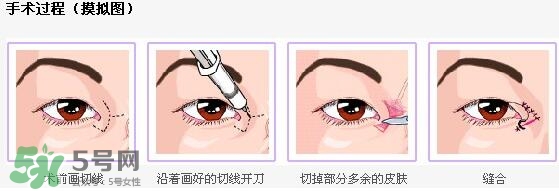哪些人需要開眼角？需要開眼角的眼睛圖片