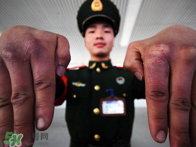 三月份還長(zhǎng)凍瘡嗎？三月份凍瘡沒(méi)好怎么辦？