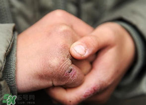三月份還長(zhǎng)凍瘡嗎？三月份凍瘡沒(méi)好怎么辦？