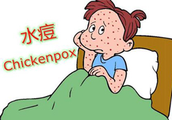 水痘是天花嗎？水痘是不是天花？