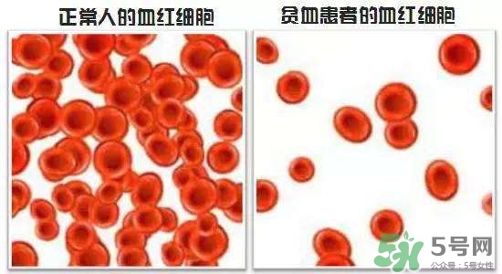 缺鐵性貧血的癥狀 缺鐵性貧血的癥狀有哪些？