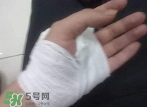 傷口化膿怎么處理？傷口化膿用什么藥好？
