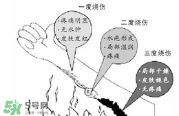 燙傷起泡要挑破嗎？燙傷起泡怎么處理？