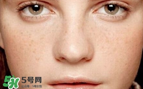 長斑是什么原因引起的？祛斑效果最好的方法