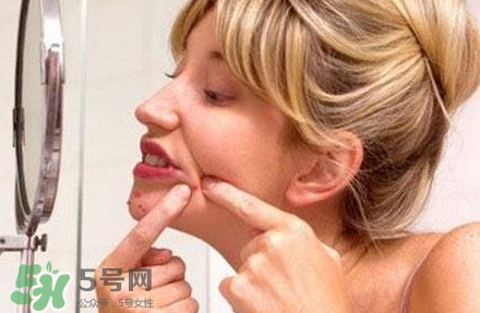 下巴長痘怎么辦？下巴長痘怎么調(diào)理