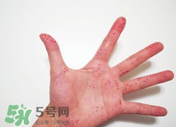 切辣椒后手很辣怎么辦？切辣椒后手很辣多久能好