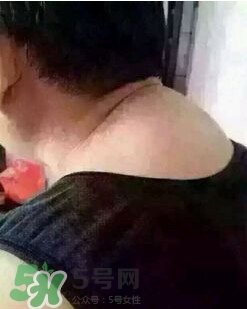 刮痧之后可以艾灸嗎？刮痧之后可不可以艾灸