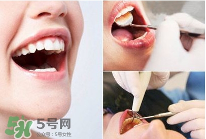 如何去掉牙結(jié)石？牙結(jié)石怎么去除