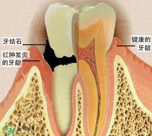 牙結(jié)石是什么？牙結(jié)石圖片