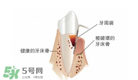 牙周炎怎么治療？牙周炎怎么治好