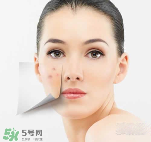 黑色痘印多久會(huì)消失？黑色痘印消失時(shí)間
