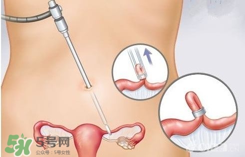 女人怎樣避孕最安全？對女人最好的避孕方法