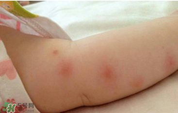 嬰兒蚊子咬了怎么消腫？嬰兒蚊子咬了怎么消腫止癢最快？