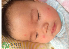 嬰兒蚊子咬了怎么消腫？嬰兒蚊子咬了怎么消腫止癢最快？
