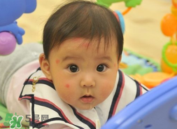嬰兒被蚊子咬了如何去紅點(diǎn)？被蚊子咬后紅點(diǎn)如何去除？