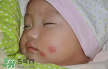嬰兒被蚊子咬了如何去紅點(diǎn)？被蚊子咬后紅點(diǎn)如何去除？