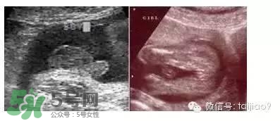 B超單數(shù)據(jù)怎么看男女？B超單看男女準(zhǔn)嗎？