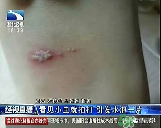 隱翅蟲有毒嗎？隱翅蟲會毀容嗎？
