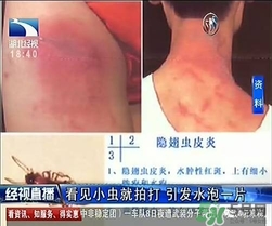 隱翅蟲有毒嗎？隱翅蟲會毀容嗎？