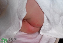 尿布疹怎么辦？寶寶尿布疹擦什么藥好？
