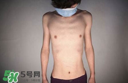 HIV真有這么可怕嗎？艾滋病的臨床表現(xiàn)主要有哪些