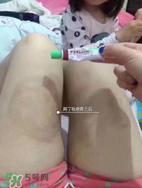 日本msd祛疤膏怎么樣？日本msd祛疤膏有用嗎？