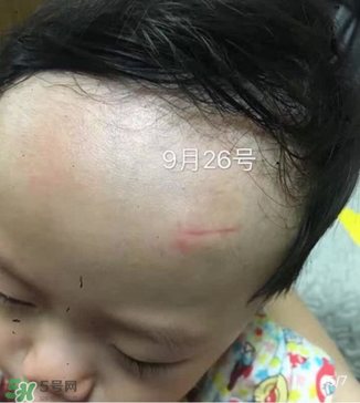 日本msd祛疤膏是抗生素嗎？日本msd祛疤膏是不是抗生素？