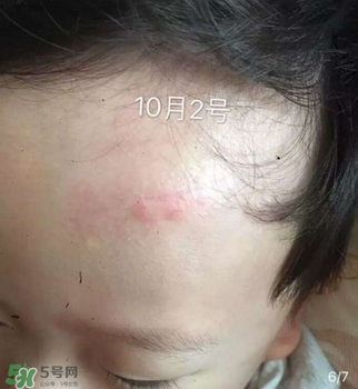 日本msd祛疤膏是抗生素嗎？日本msd祛疤膏是不是抗生素？