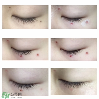 藥水點痣和激光點痣哪個好？各有什么優(yōu)缺點