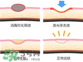 藥水點痣和激光點痣哪個好？各有什么優(yōu)缺點