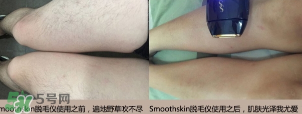 smoothskin和slikn infinity哪個(gè)好？smoothskin脫毛儀怎么樣