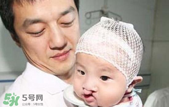 兔唇是什么？兔唇是什么原因造成的？