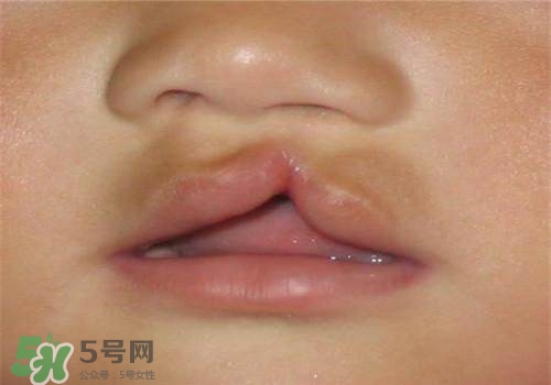 兔唇能檢查出來嗎？兔唇能完全修復(fù)嗎？